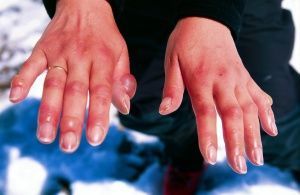 Обморожение рук: эффективные способы помощи и ухода