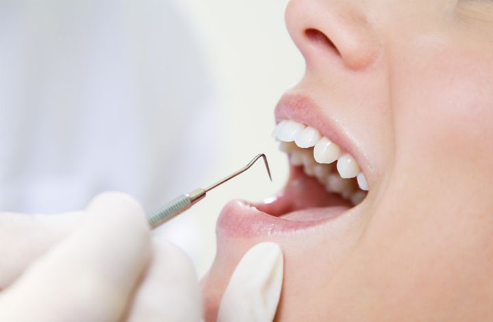 Что делать пациенту, если выпала пломба из зуба?
